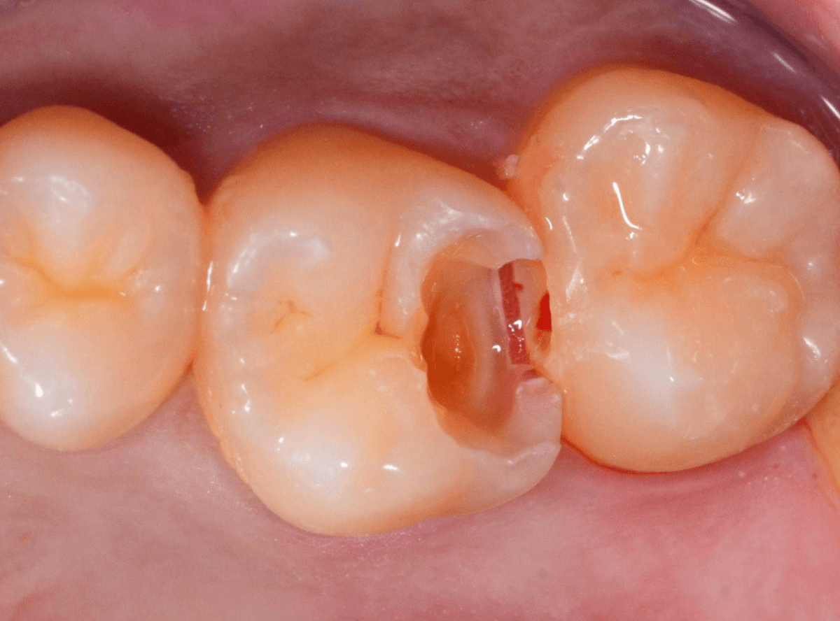 歯と歯の間の虫歯1-5