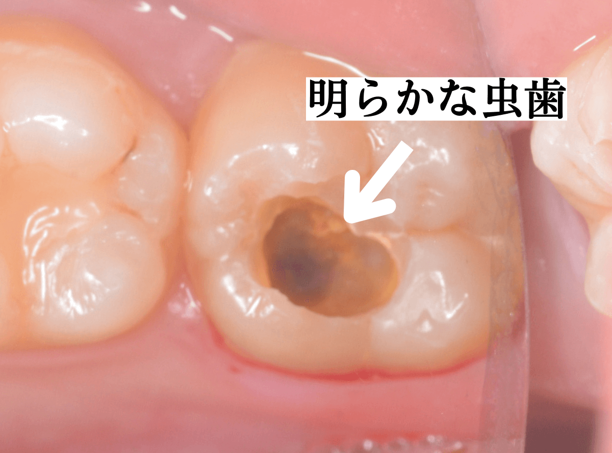 つめものの下の深い虫歯(画像)2-4