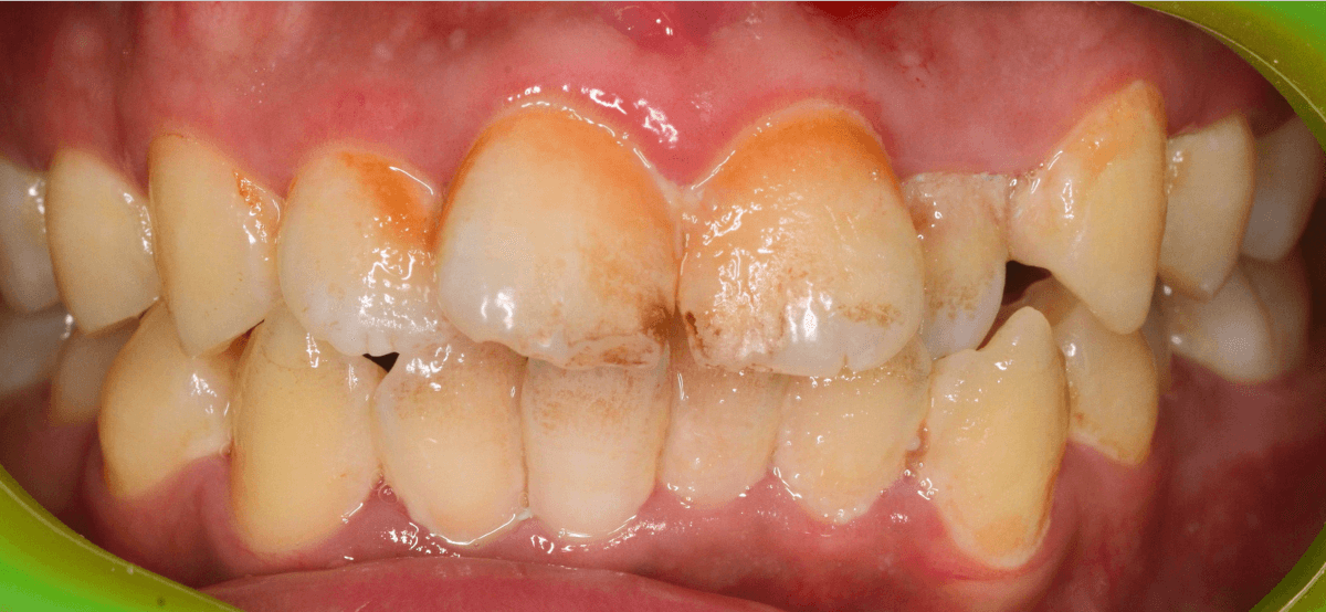 歯肉の中の歯石（歯肉縁下歯石）除去(画像）1-1