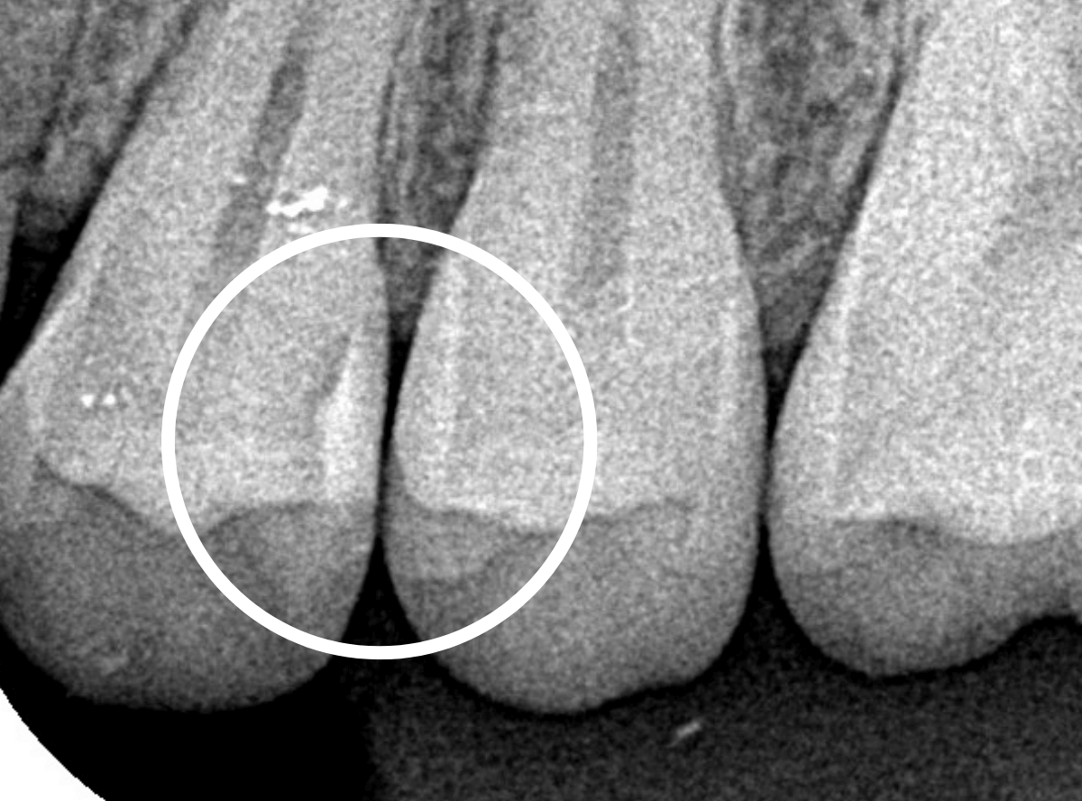他の歯医者さんで虫歯と言われなかった虫歯の話(画像)3