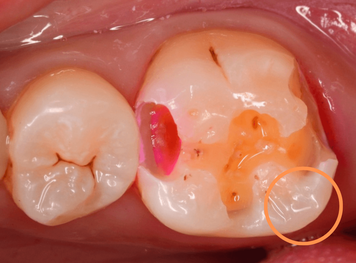 歯と歯の間の虫歯5-4