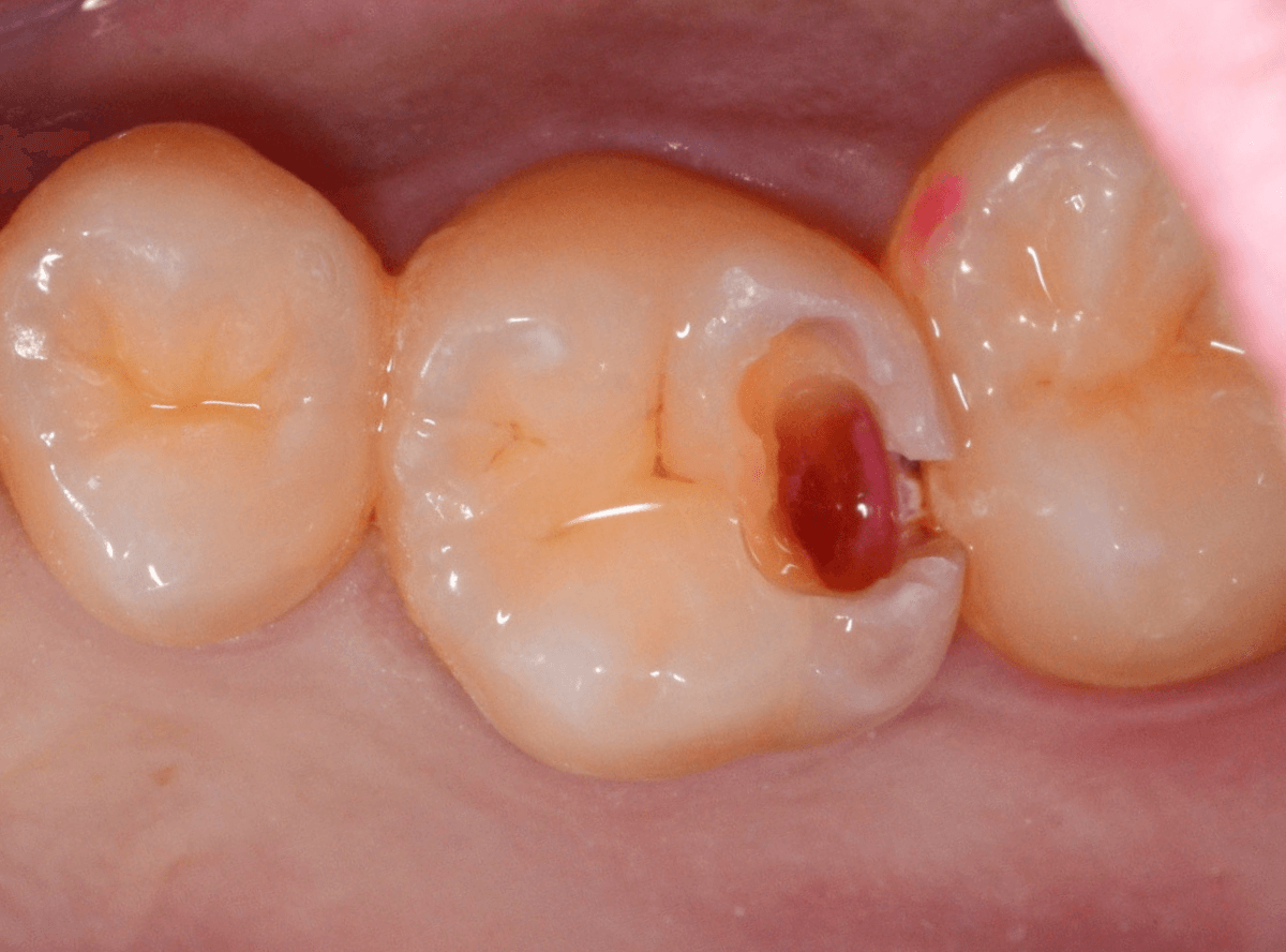 歯と歯の間の虫歯1-4