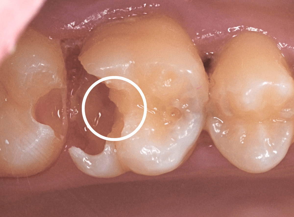 歯と歯の間の虫歯4-5