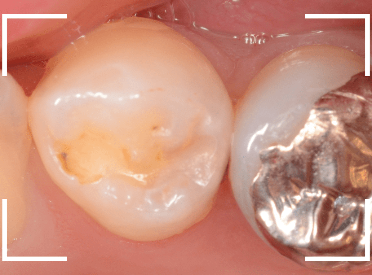 歯と歯の間の虫歯6-2
