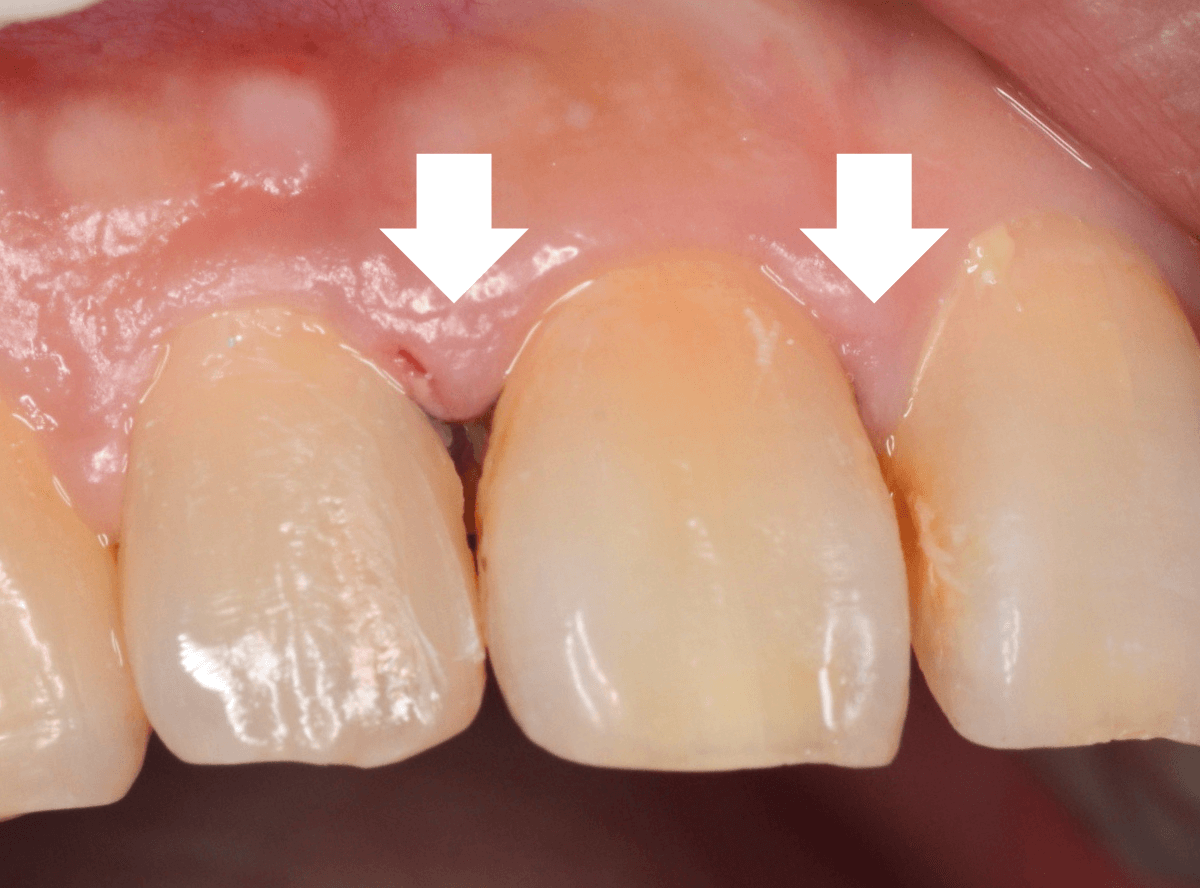 歯肉の中の歯石（歯肉縁下歯石）除去(画像）2-1