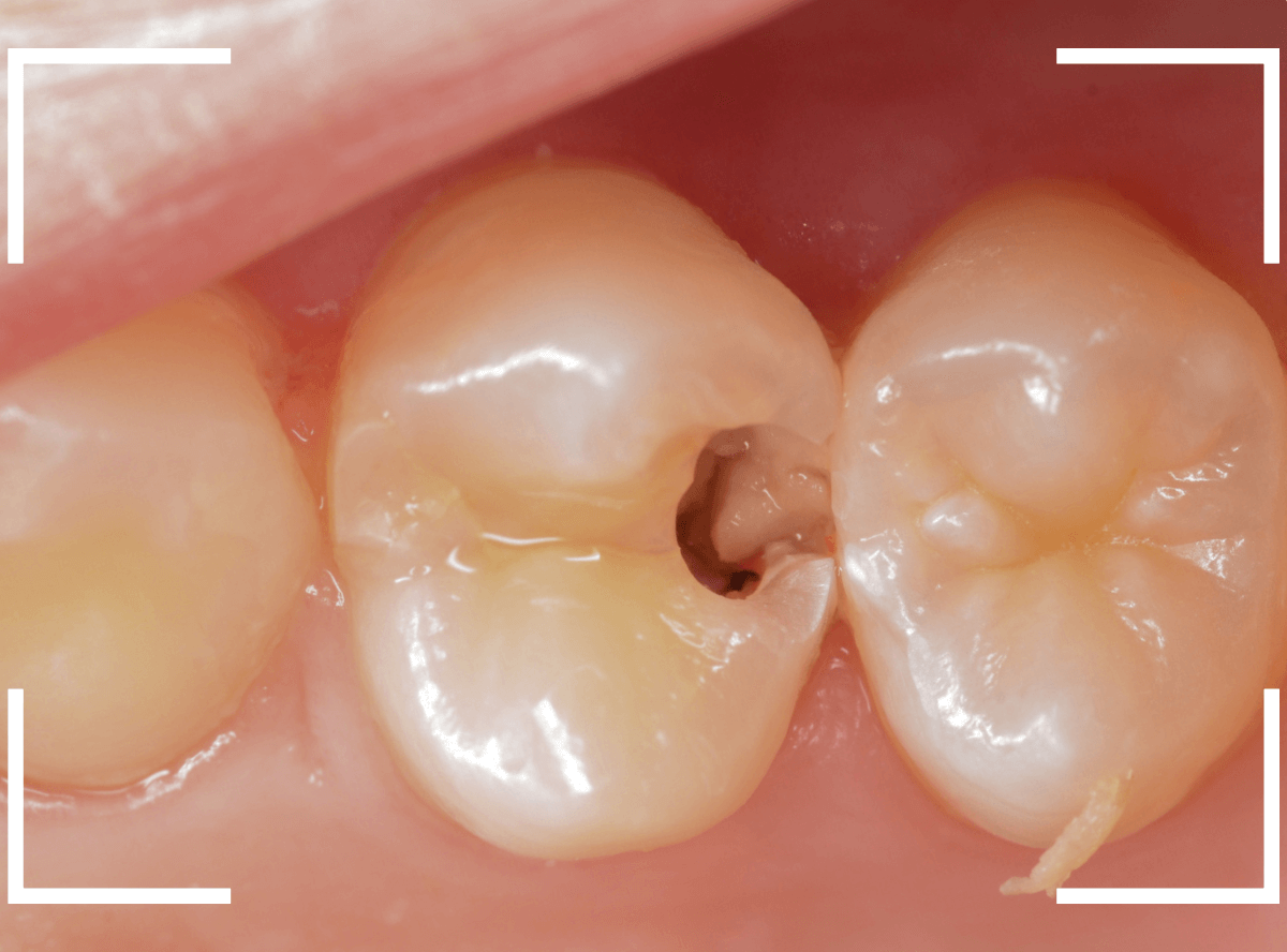 歯と歯の間の虫歯9-3
