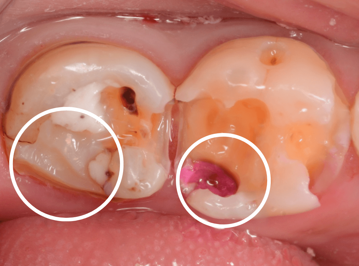 つめものの下の深い虫歯(画像)9-4