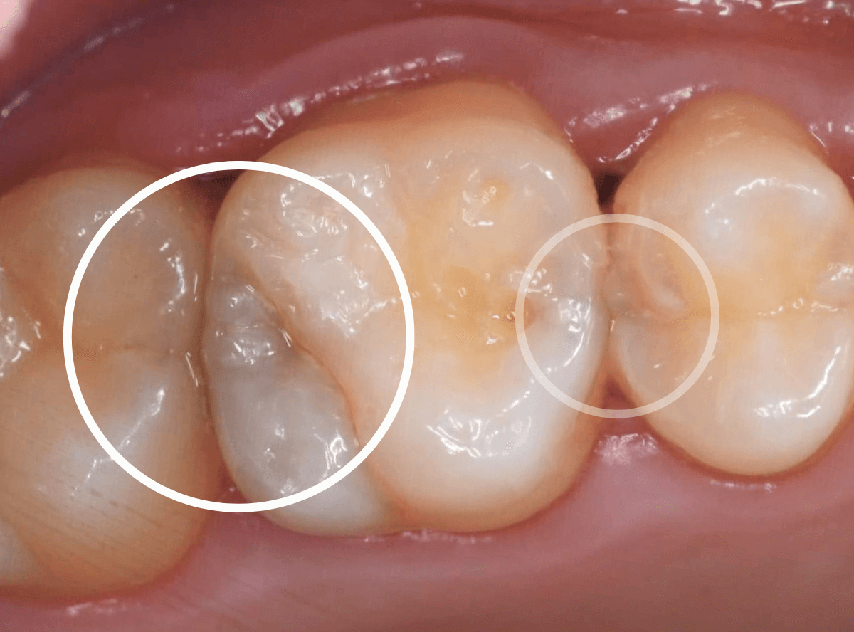 歯と歯の間の虫歯4-1