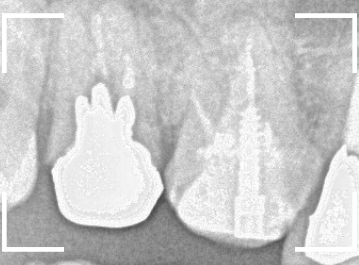 歯の土台の再治療3-2