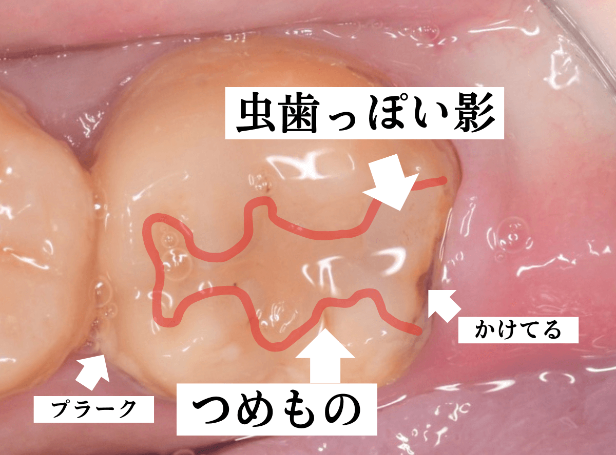 つめものの下の深い虫歯(画像)3-2