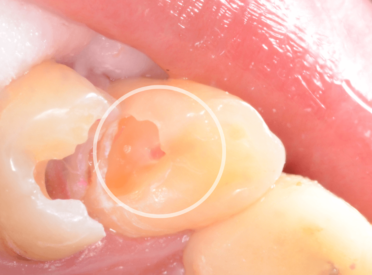 歯と歯の間の虫歯2-5