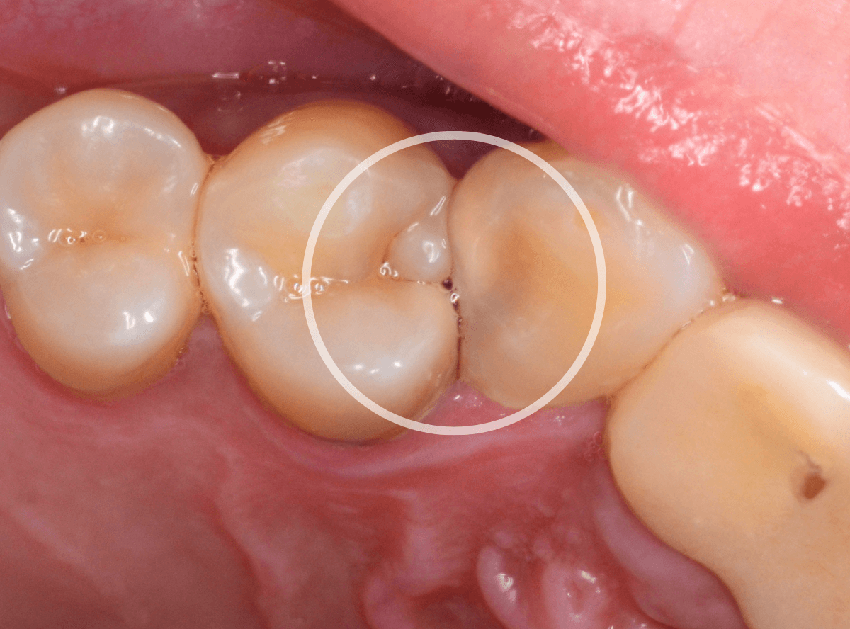 歯と歯の間の虫歯2-1