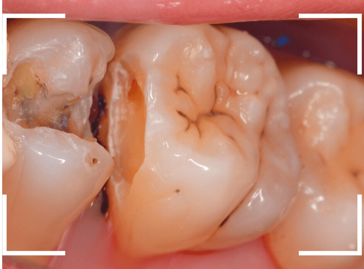 歯と歯の間の虫歯8-5