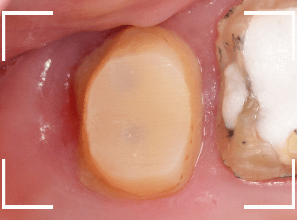 歯の土台の再治療2-4