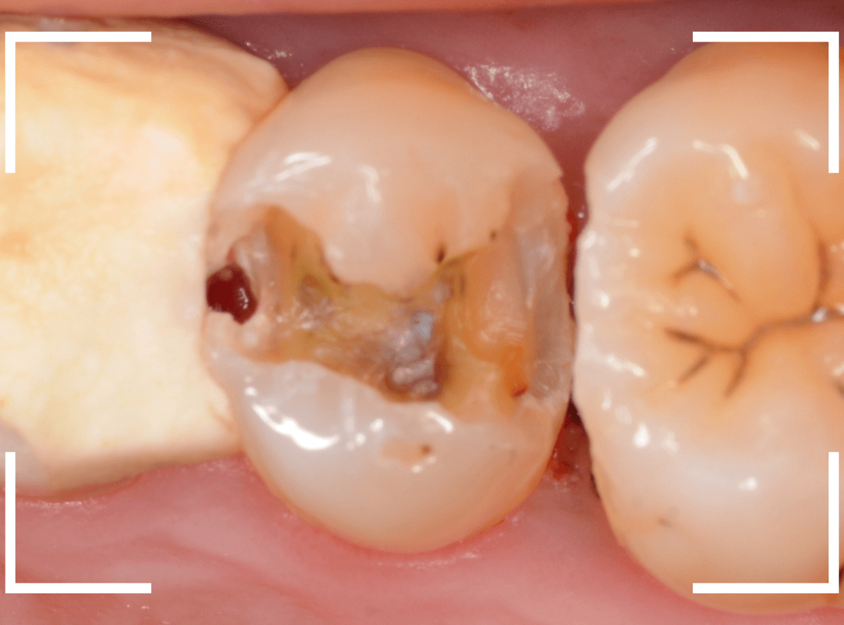 歯と歯の間の虫歯8-4