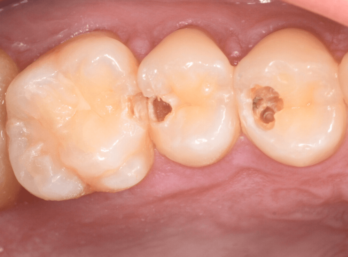 歯と歯の間の虫歯3-3
