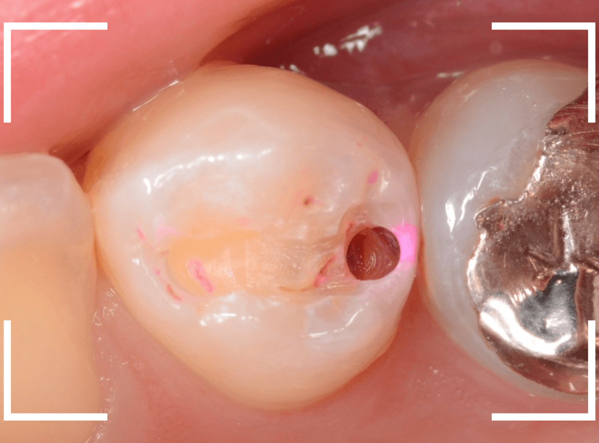 歯と歯の間の虫歯6-3