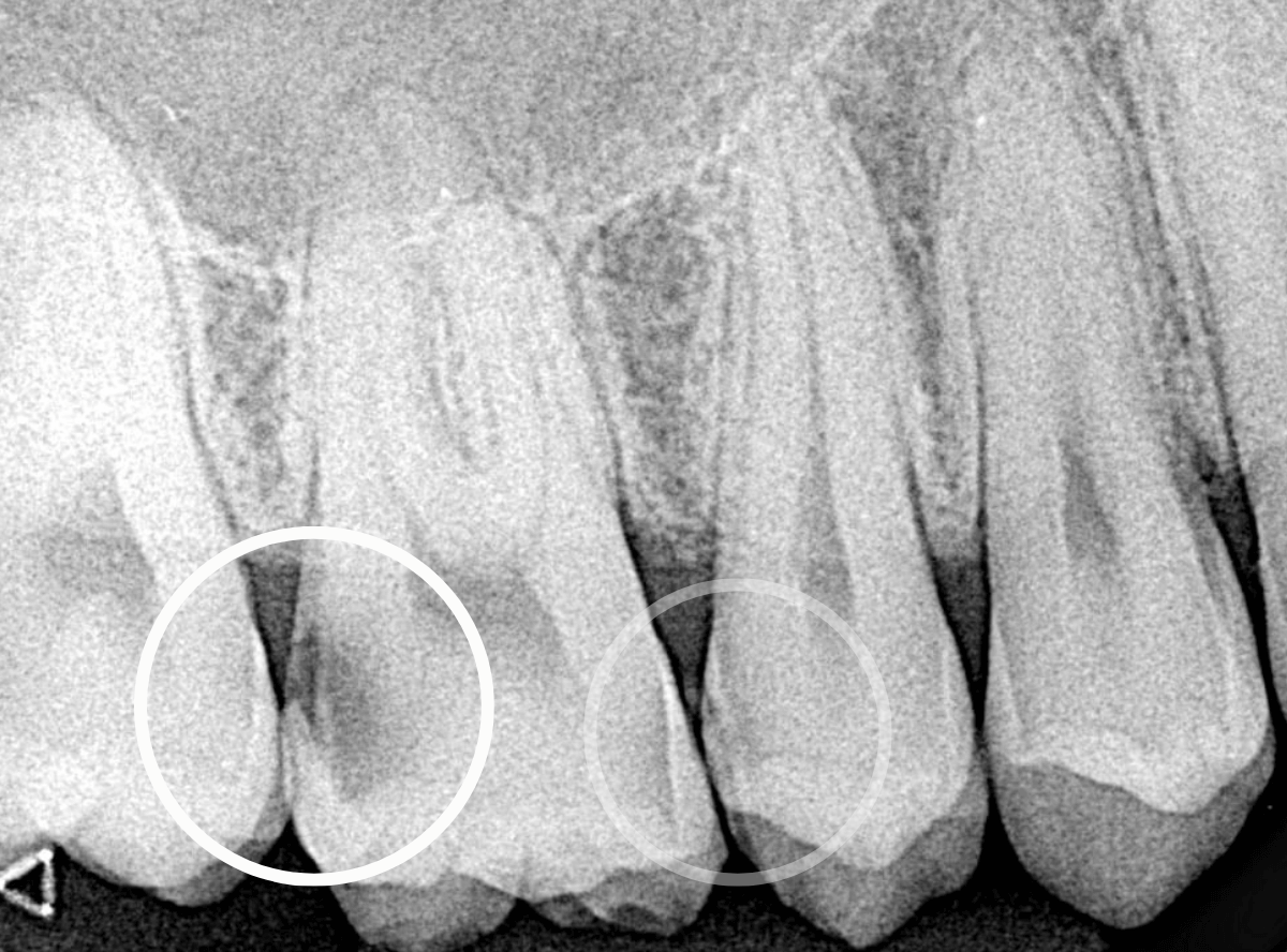 歯と歯の間の虫歯4-2