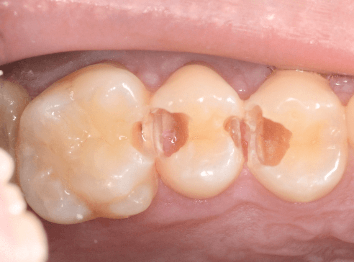 歯と歯の間の虫歯3-4