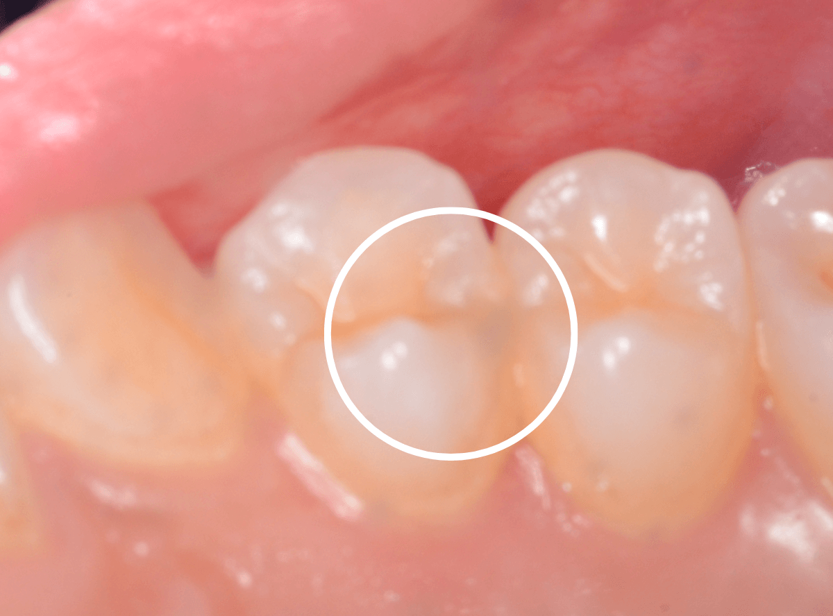 他の歯医者さんで虫歯と言われなかった虫歯の話(画像)2