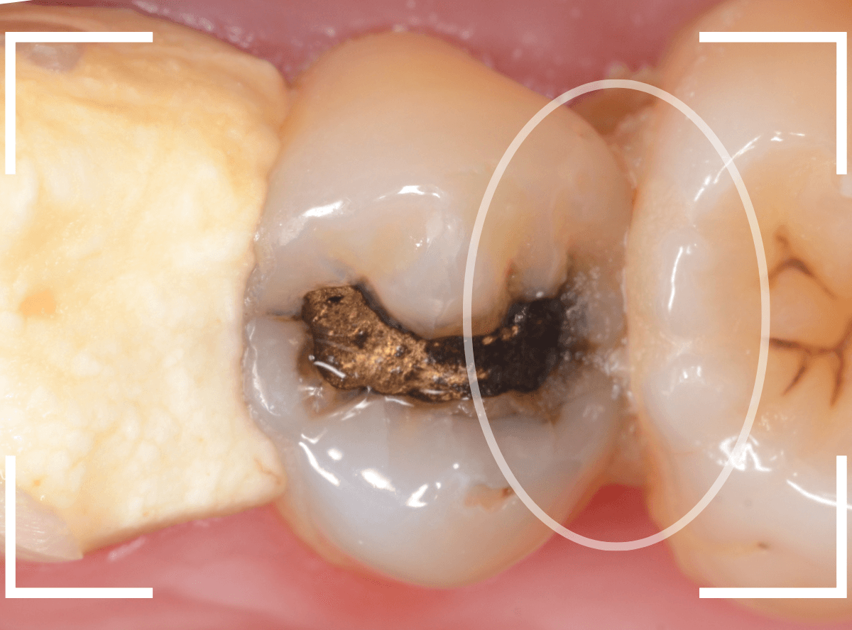 歯と歯の間の虫歯8-1
