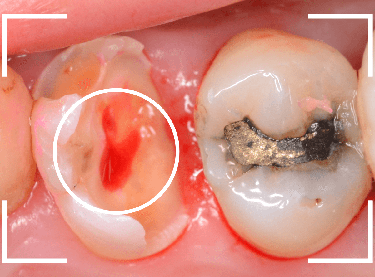 つめものの下の深い虫歯(画像)10-3
