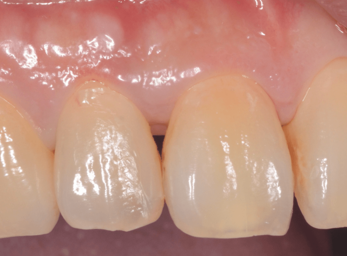歯肉の中の歯石（歯肉縁下歯石）除去(画像）2-4