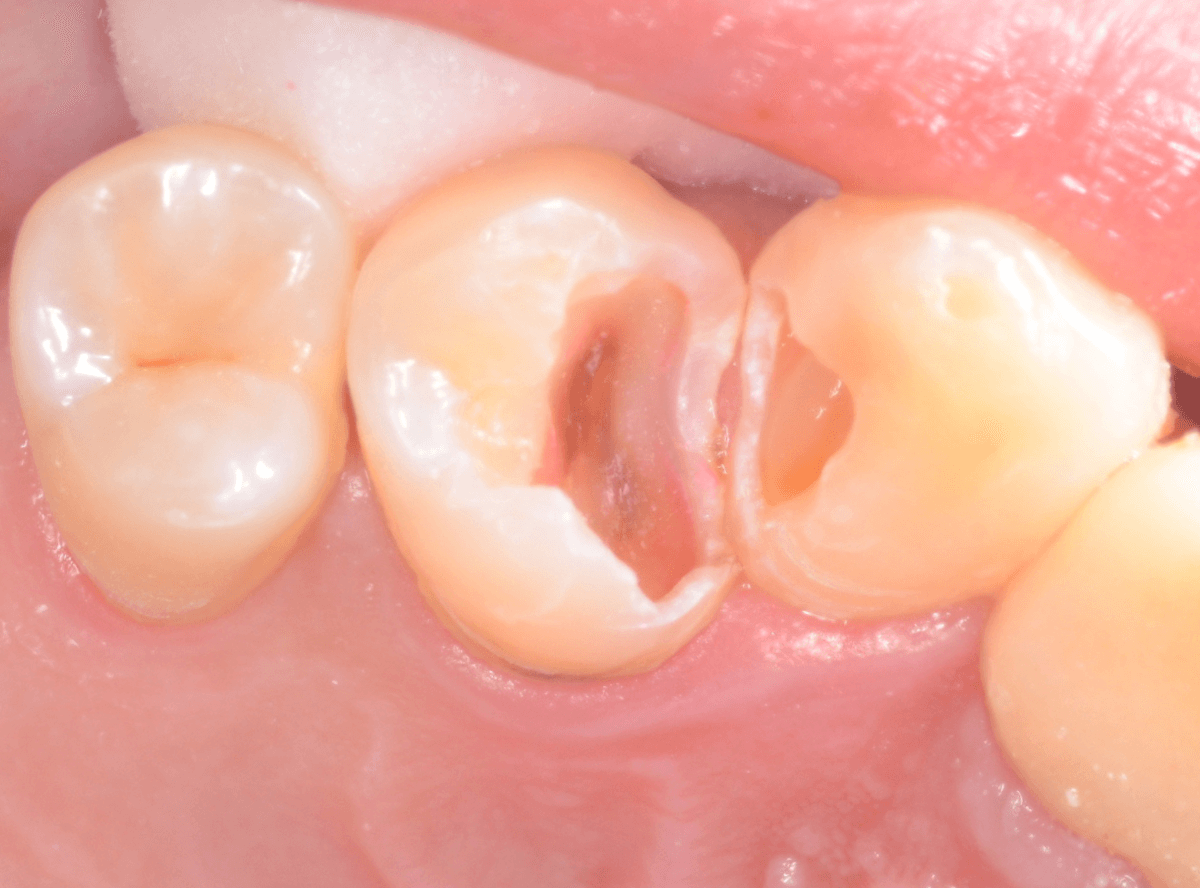 歯と歯の間の虫歯2-4