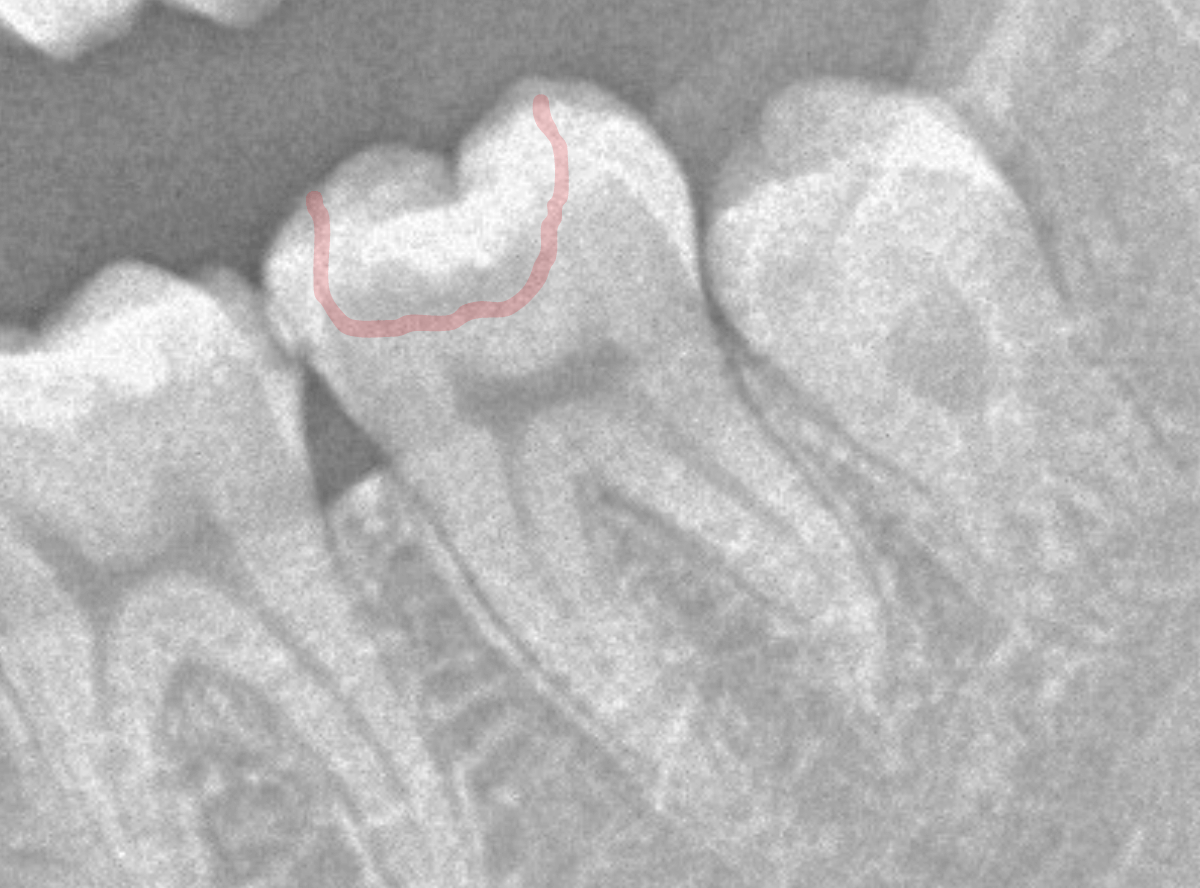 つめものの下の深い虫歯(画像)2-3