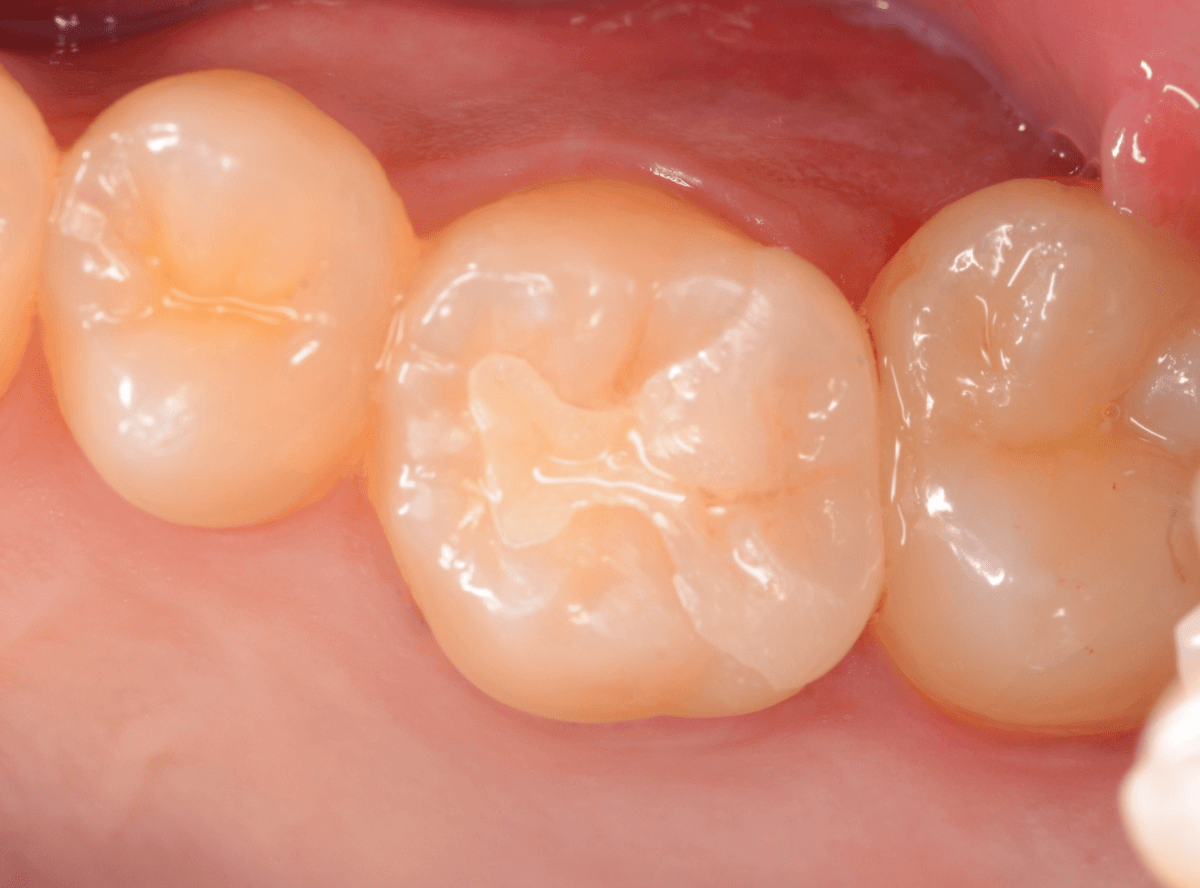 歯と歯の間の虫歯1-7