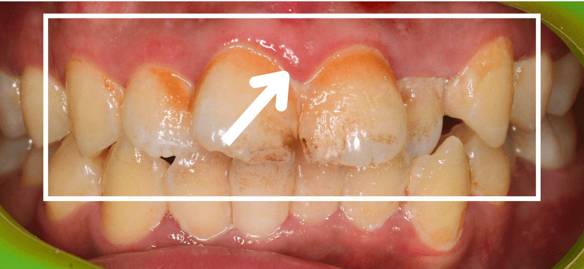 歯肉の中の歯石（歯肉縁下歯石）除去(画像）1-2