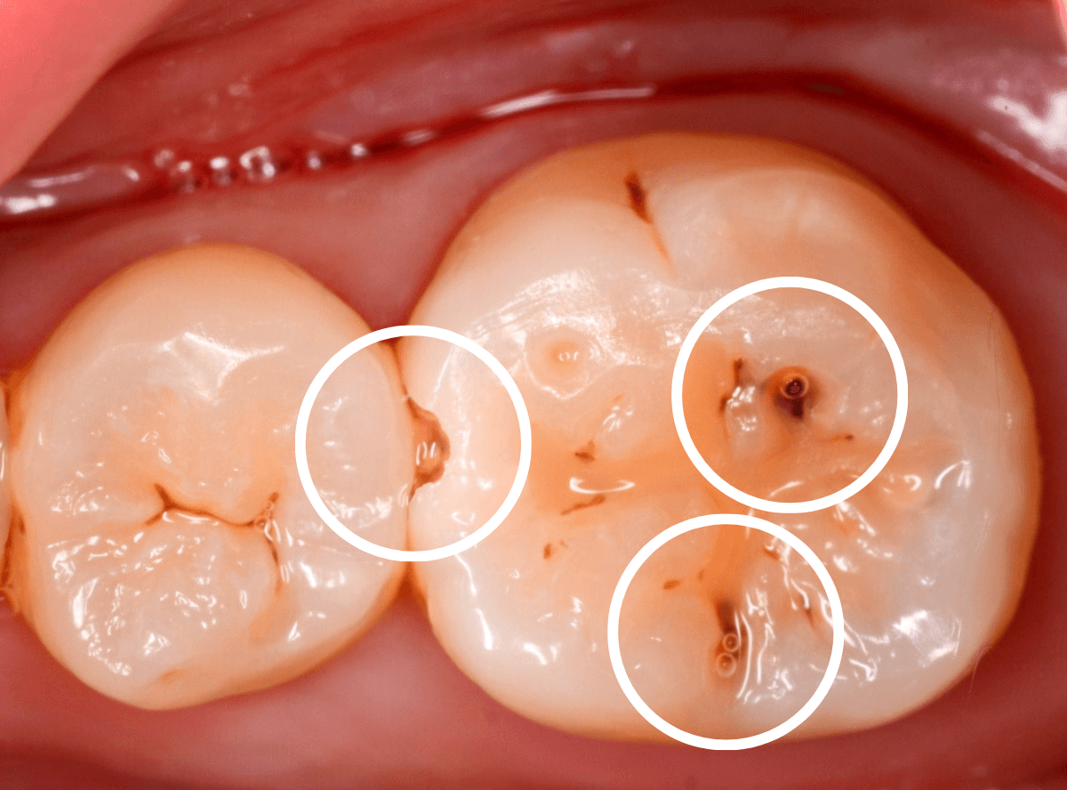 歯と歯の間の虫歯5-1