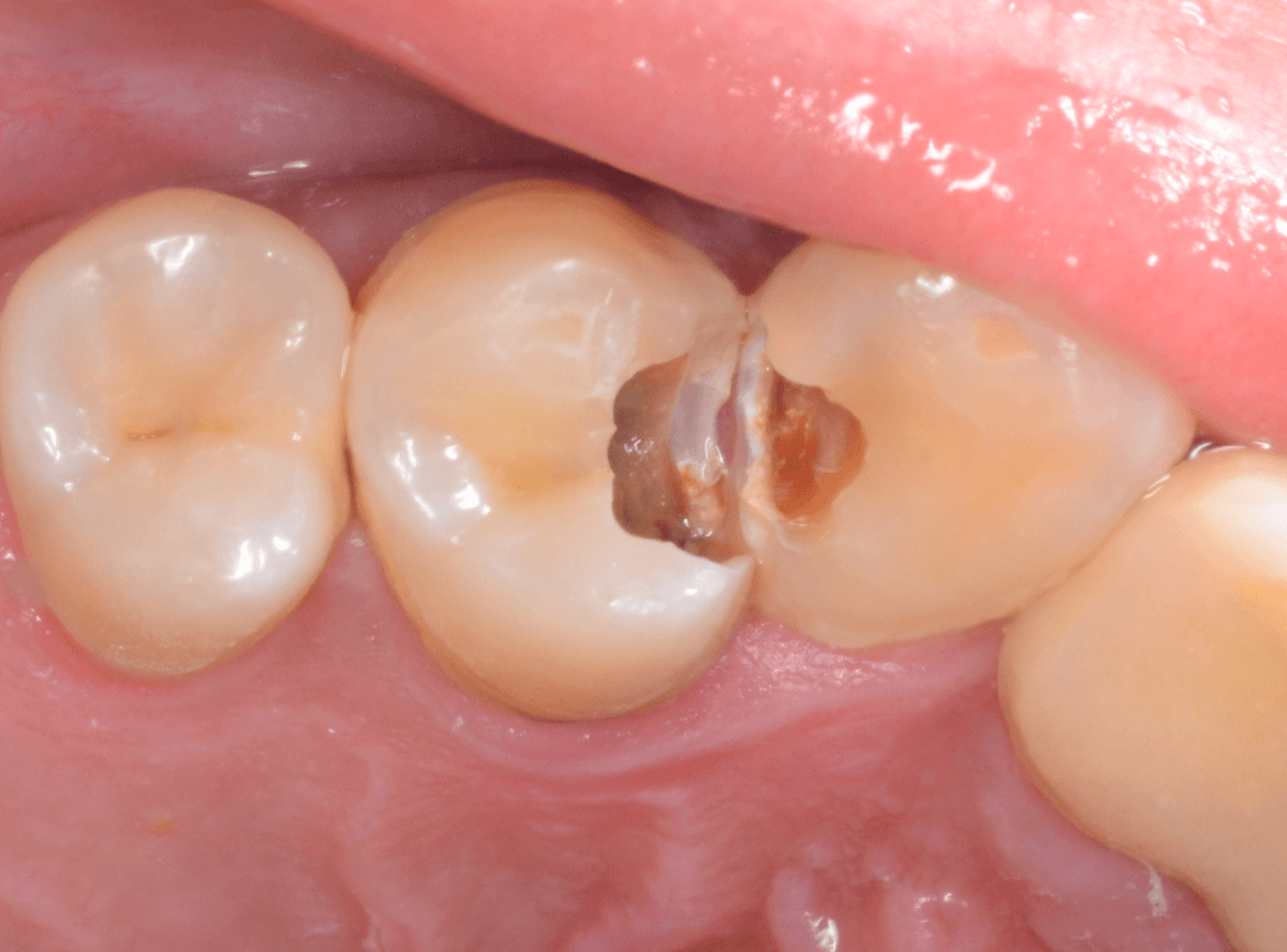 歯と歯の間の虫歯2-2