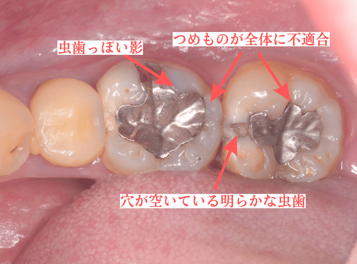 つめものの下の深い虫歯(画像)1-1