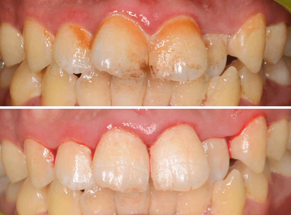 歯肉の中の歯石（歯肉縁下歯石）除去(画像）1-5