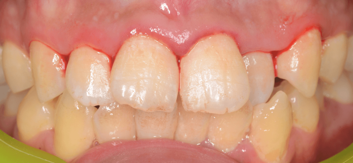 歯肉の中の歯石（歯肉縁下歯石）除去(画像）1-4