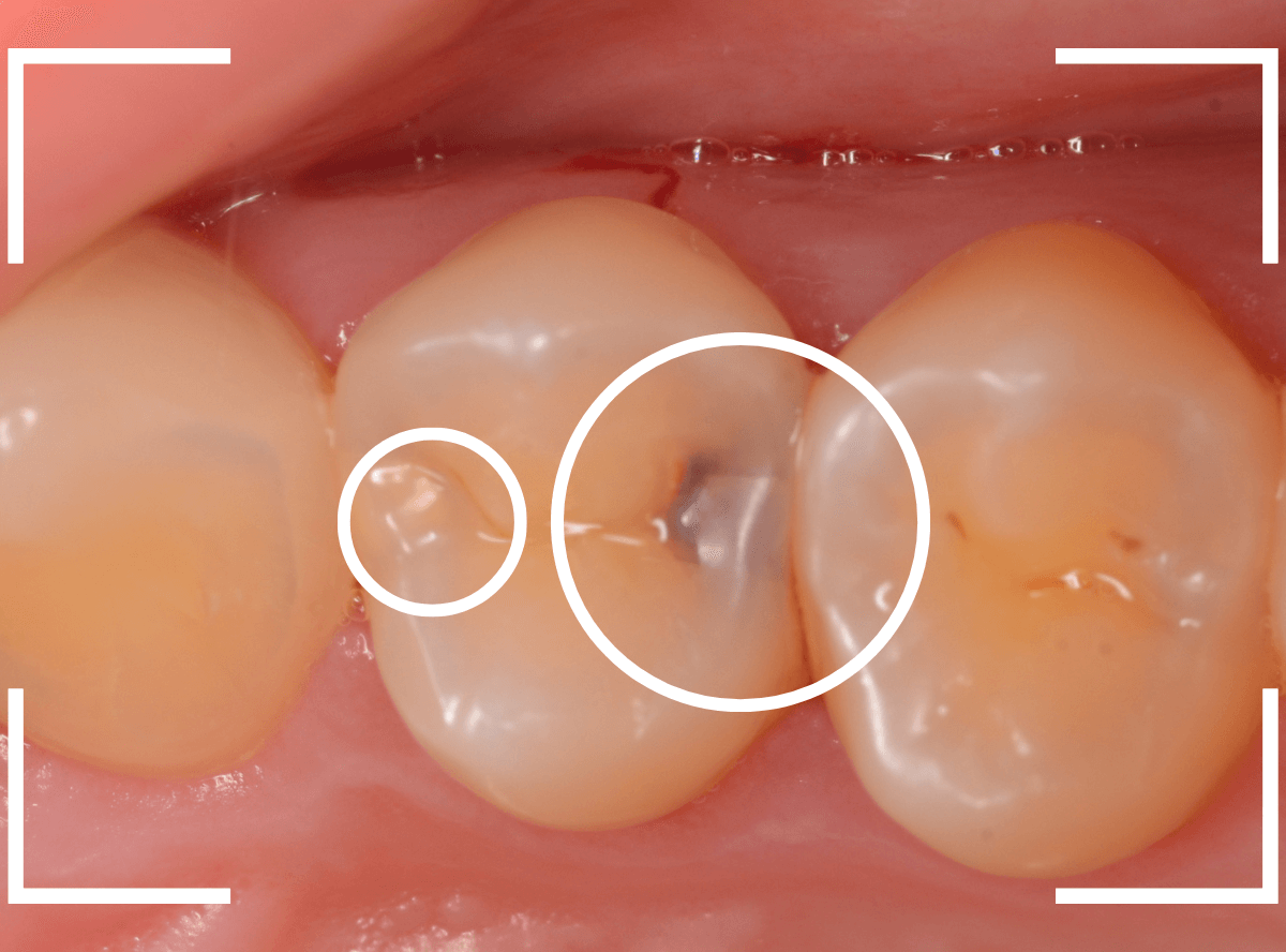 歯と歯の間の虫歯7-1