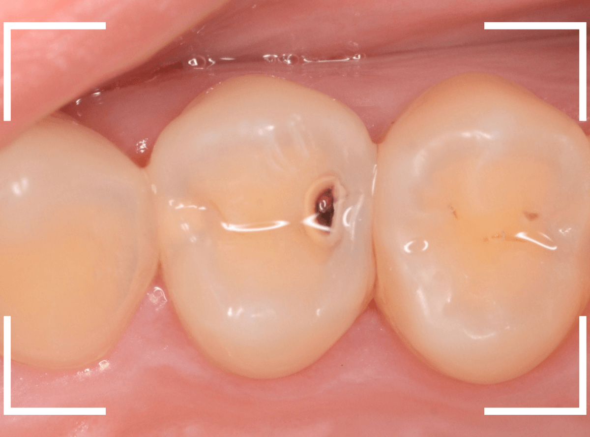 歯と歯の間の虫歯7-3