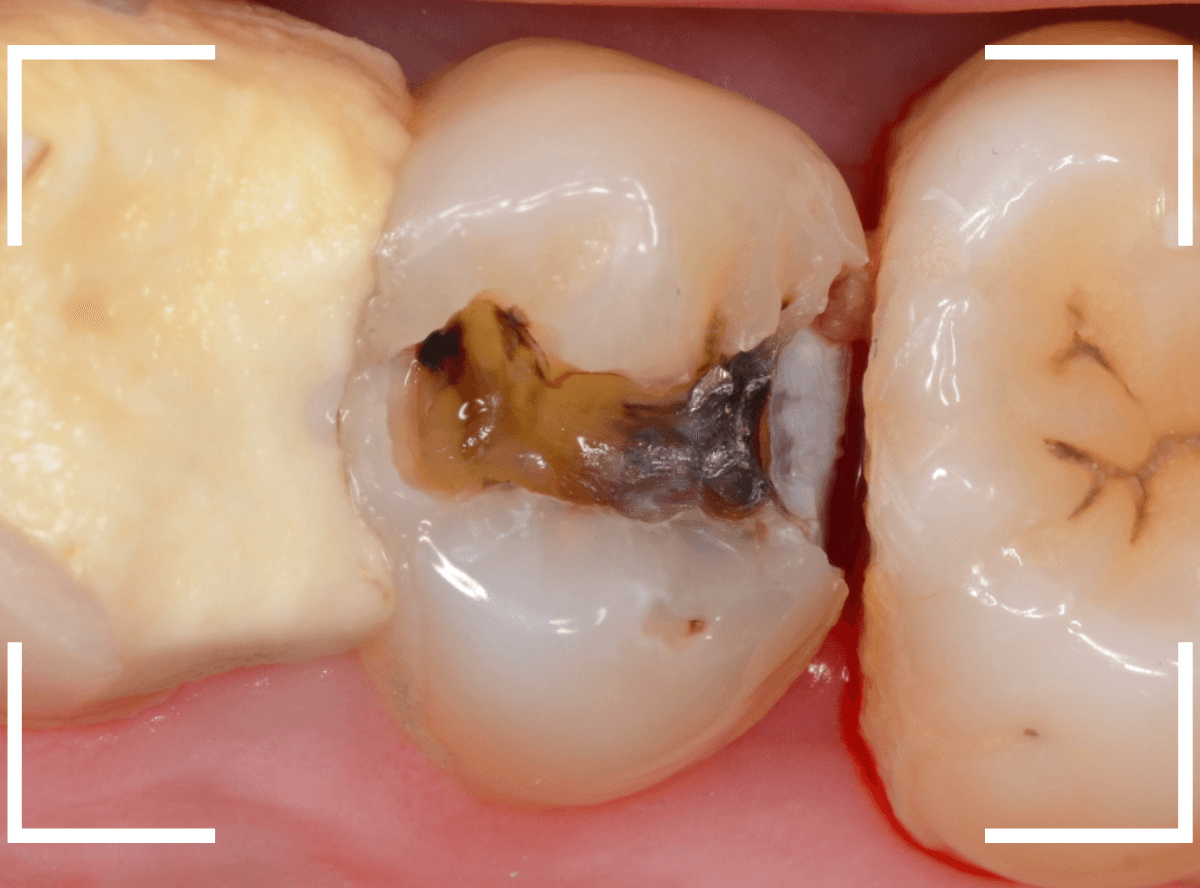 歯と歯の間の虫歯8-3