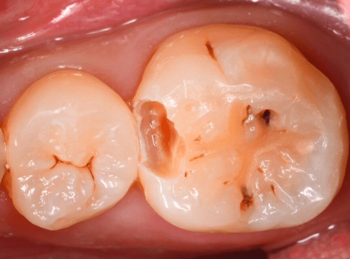 歯と歯の間の虫歯5-3