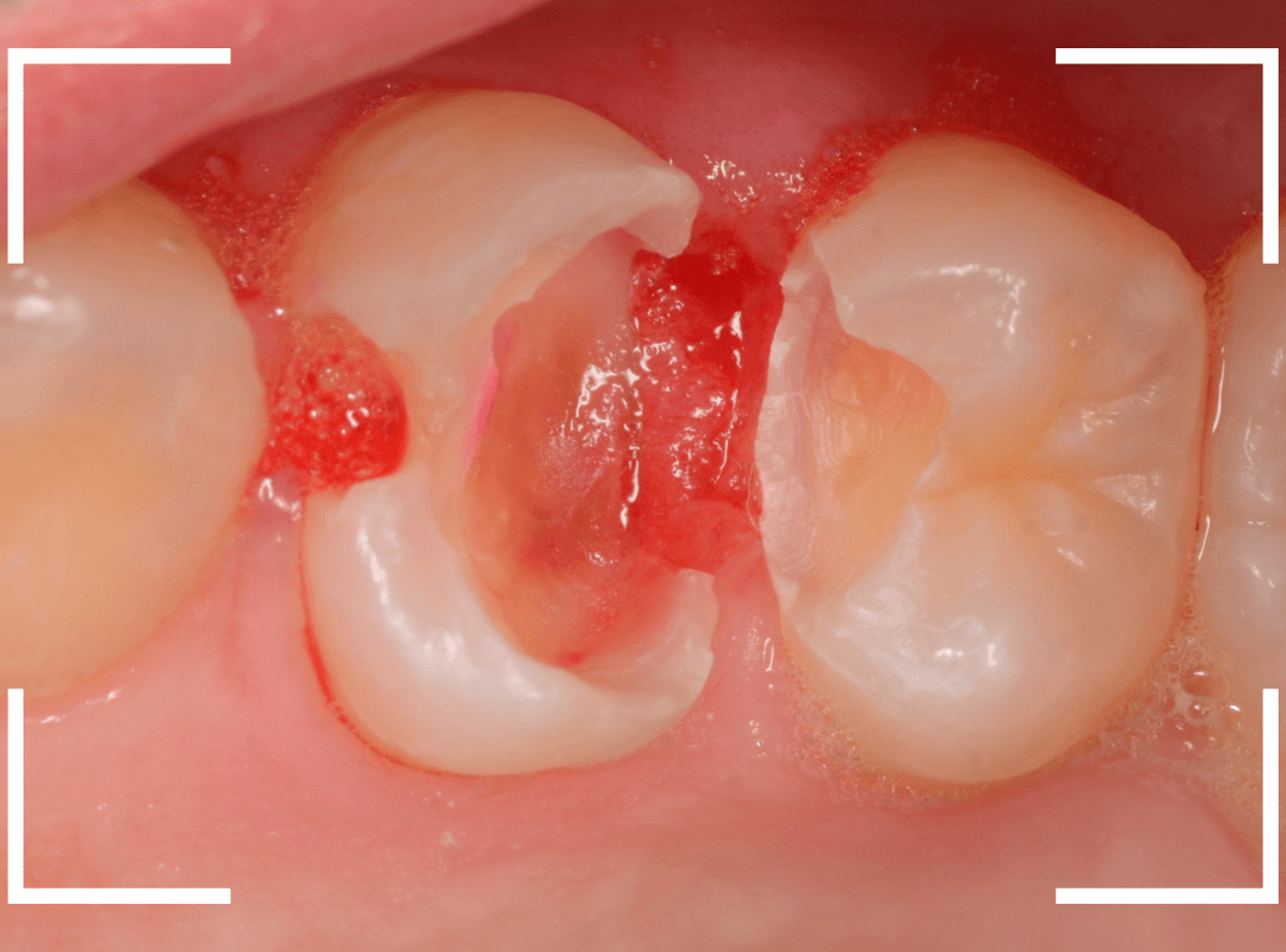 歯と歯の間の虫歯9-4