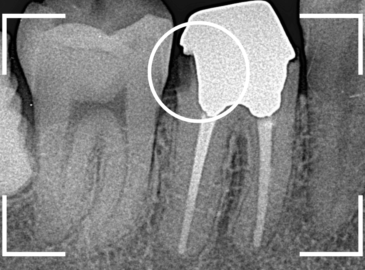 歯の土台の再治療1-2