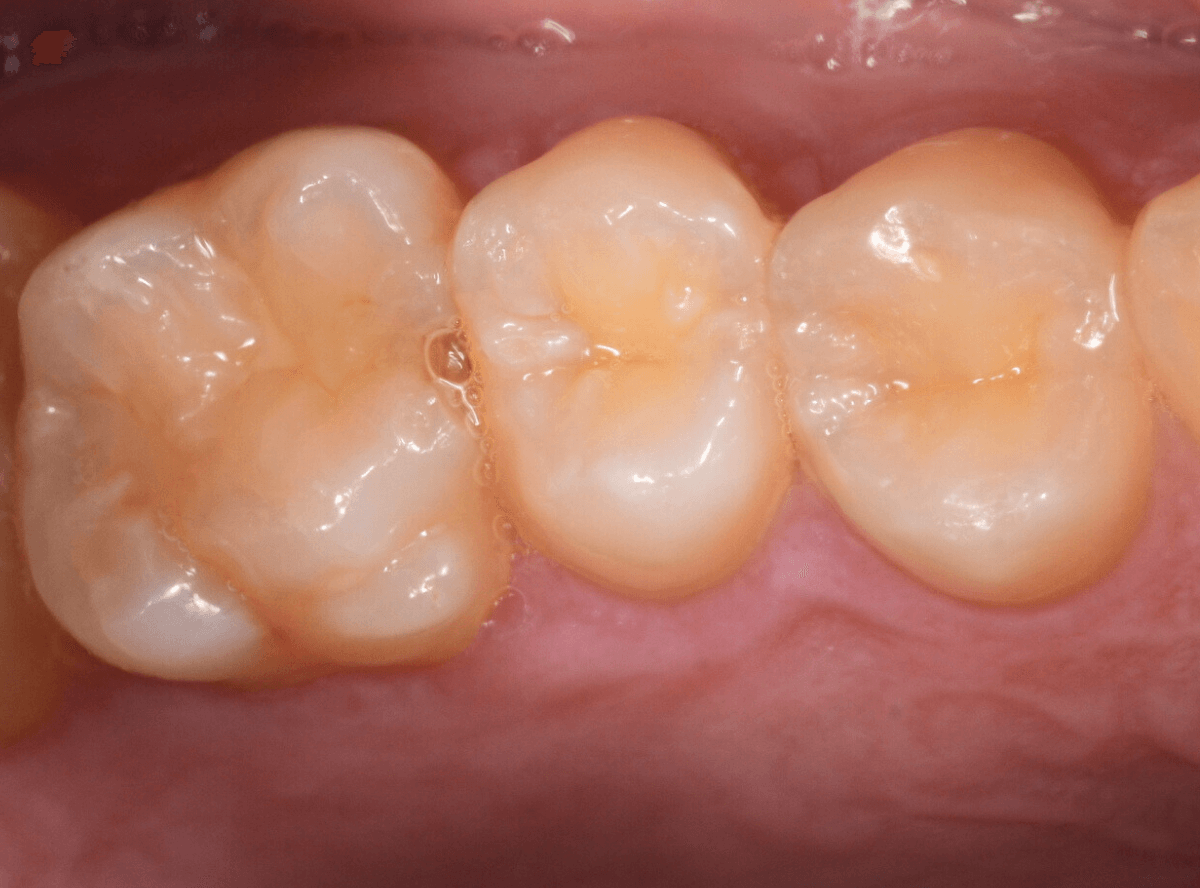 歯と歯の間の虫歯3-1