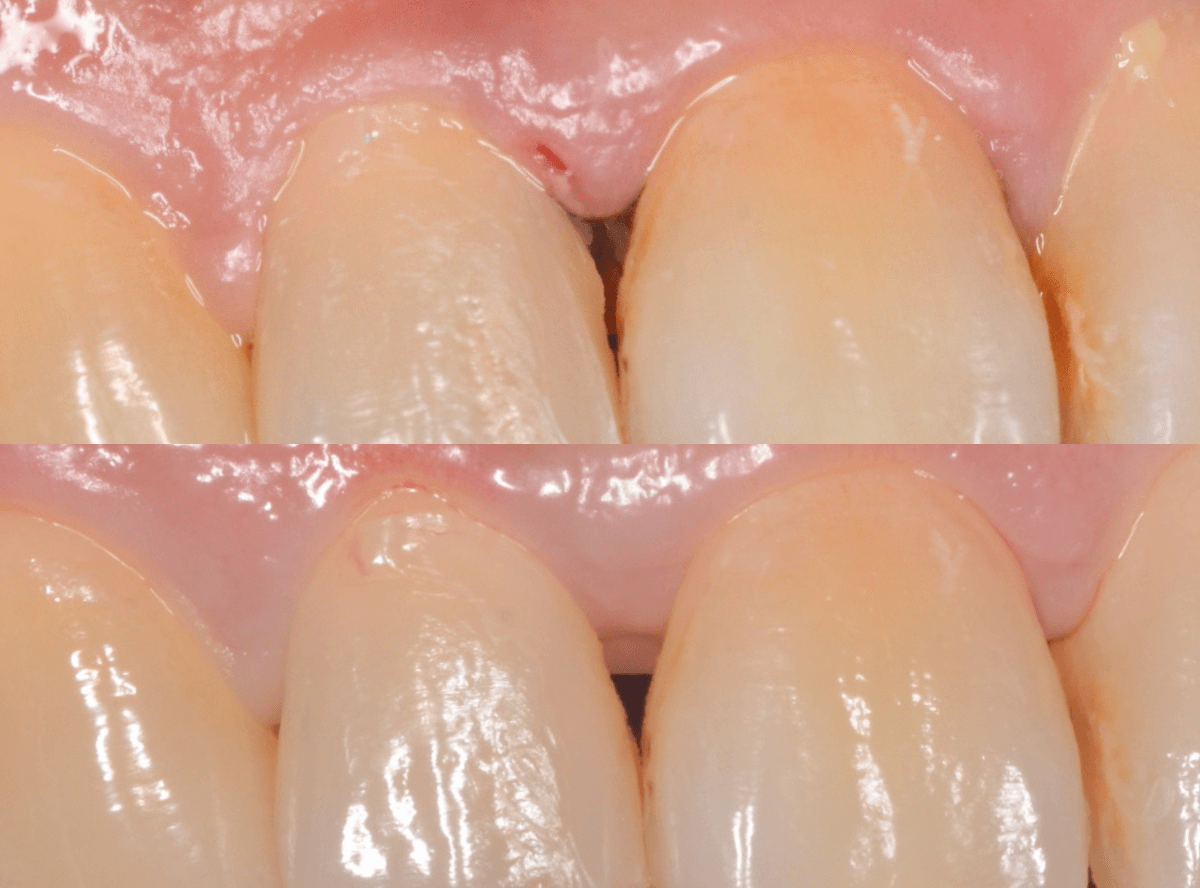 歯肉の中の歯石（歯肉縁下歯石）除去(画像）2-5