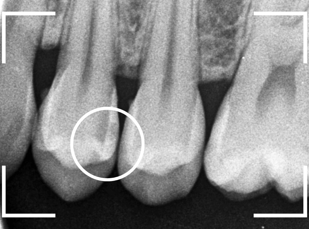 歯と歯の間の虫歯7-2