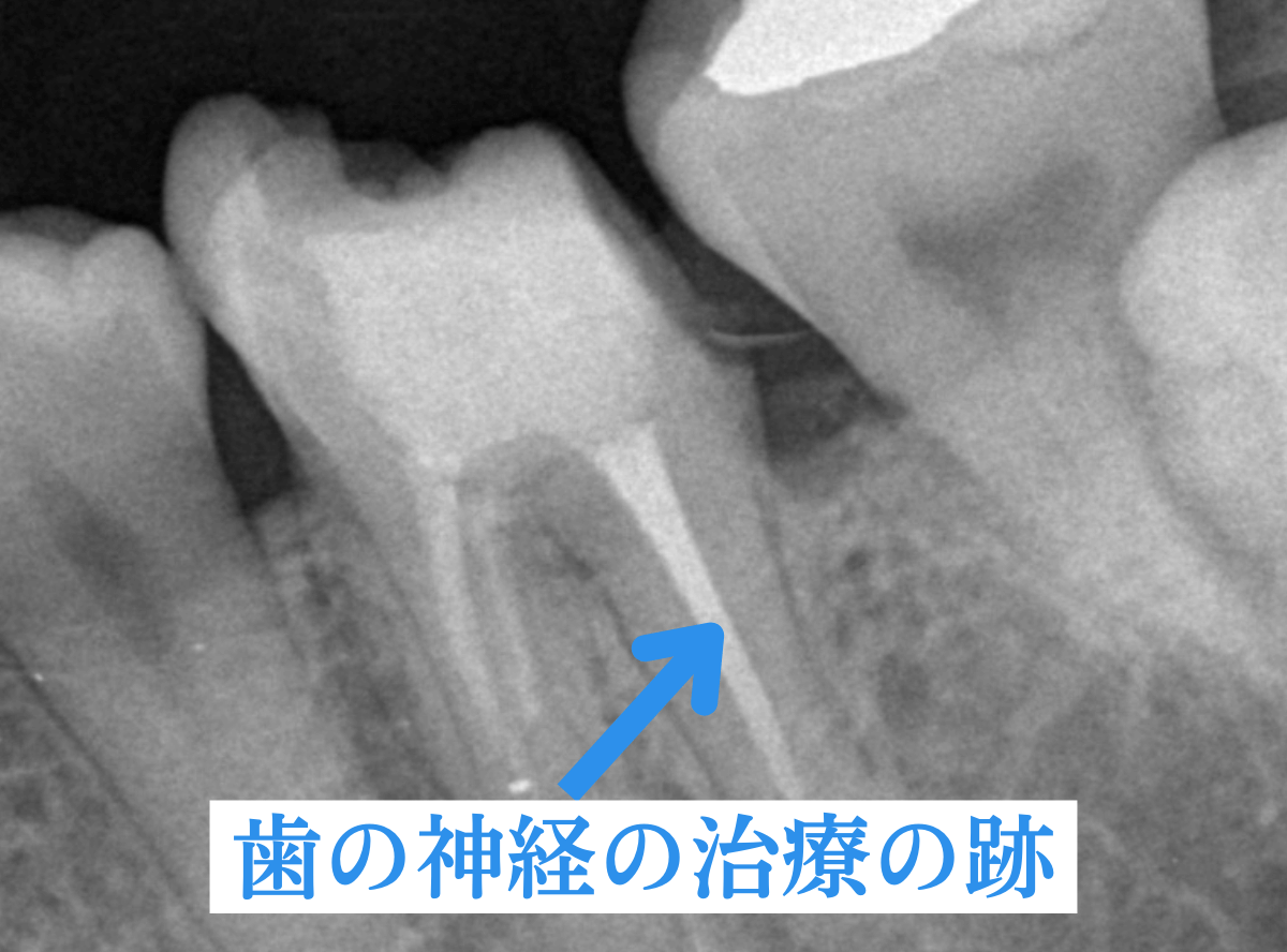 つめものが取れた歯の治療の画像-2