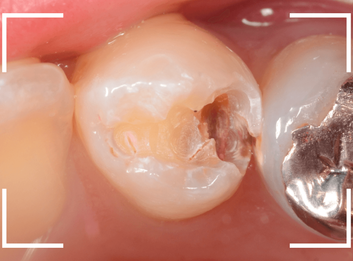 歯と歯の間の虫歯6-4