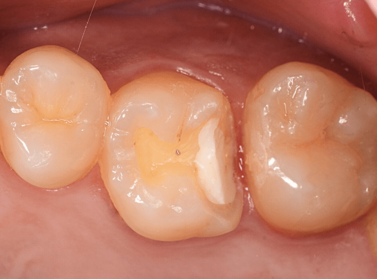 歯と歯の間の虫歯1-6