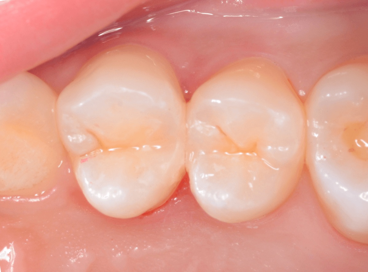 他の歯医者さんで虫歯と言われなかった虫歯の話(画像)6