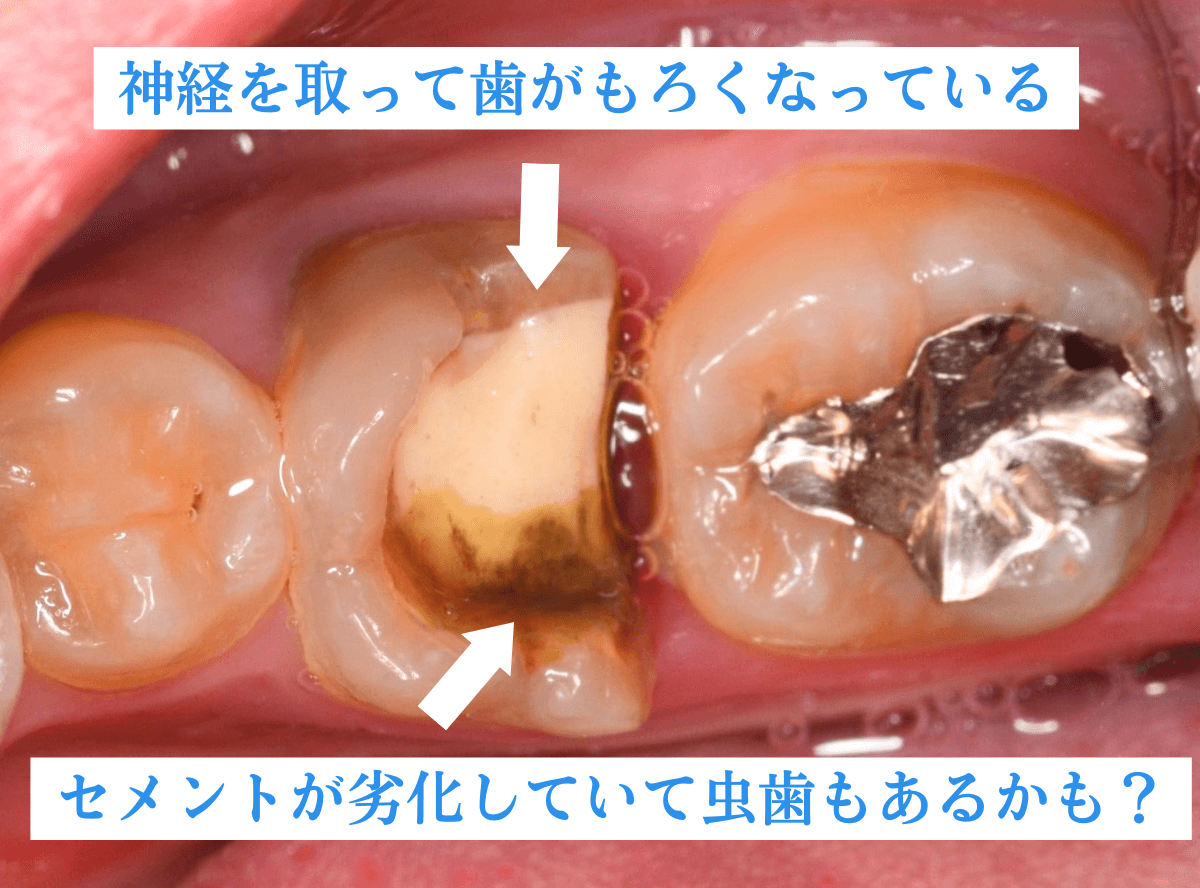 つめものが取れた歯の治療の画像-4